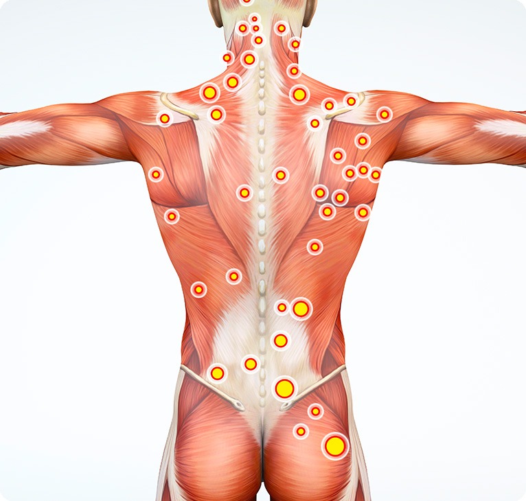What Are Trigger Points? | Lifepath Massage Therapy | Lifepath Wellness & Dental